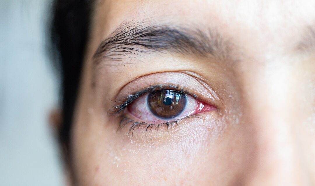 Watery Eyes: A Surprising Symptom of Dry Eye