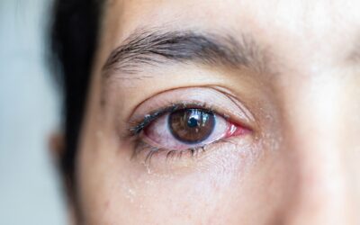 Watery Eyes: A Surprising Symptom of Dry Eye