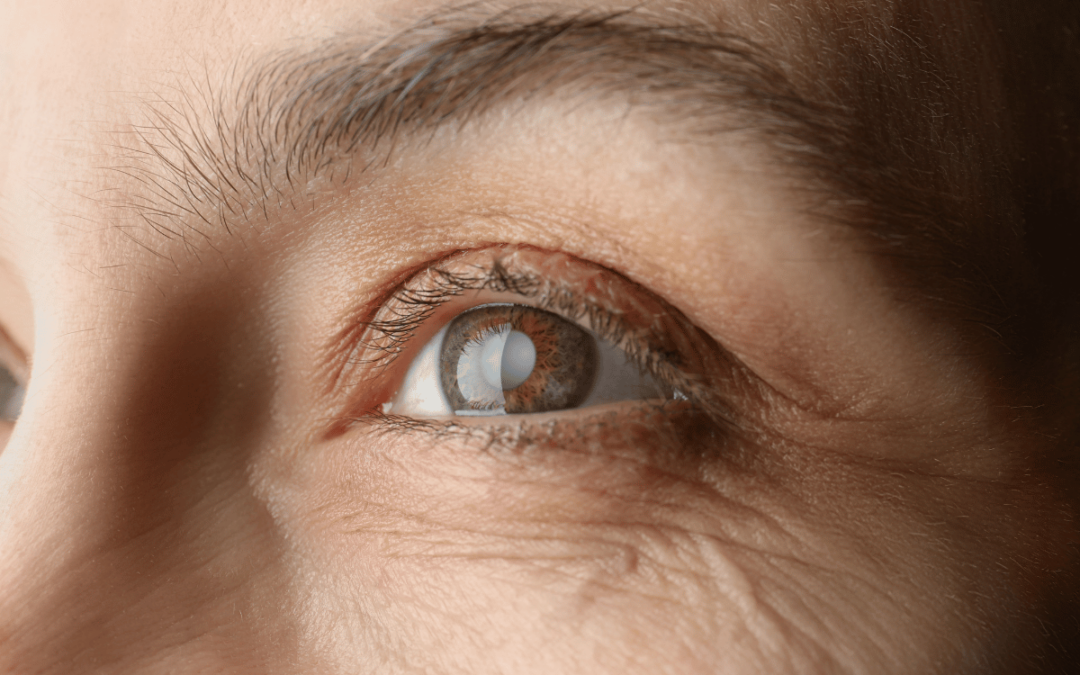 How Do You Know When You Need Cataract Surgery?